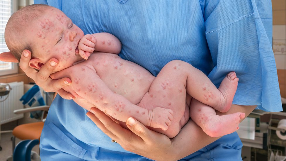 Baby with measles